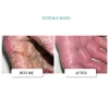 BF_Eczema@2x